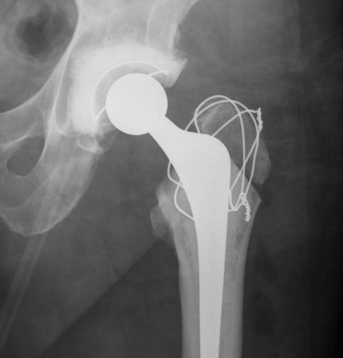 Standard GT Osteotomy Wire Fixation